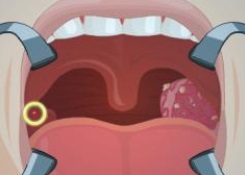 Operate Now! Dental Implant